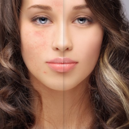 Oily - Acne Prone Skin